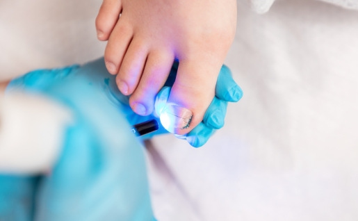 Traitement par photopolymérisation